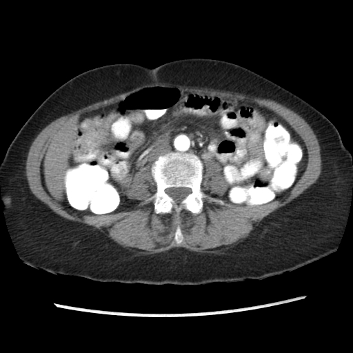 File:Acute appendicitis (Radiopaedia 52672-58589 Axial C+ arterial phase 4).jpg