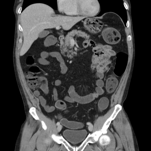 Acute appendicitis (Radiopaedia 66513-75790 Coronal C+ portal venous phase 27).jpg