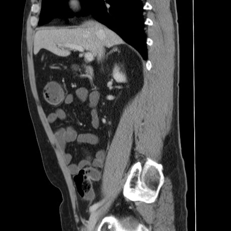 File:Acute appendicitis (Radiopaedia 66513-75790 Sagittal C+ portal venous phase 59).jpg