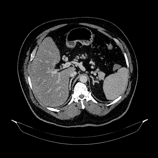 File:Acute appendicitis (Radiopaedia 79950-93224 Axial C+ portal venous phase 30).jpg