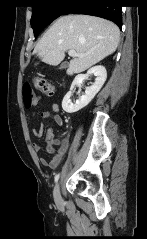 Acute appendicitis - large appendicoliths (Radiopaedia 61805-69820 Sagittal C+ portal venous phase 80).jpg