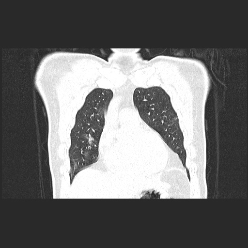 Acute appendicitis and COVID 19 pneumonia (Radiopaedia 76604-88380 G 18).jpg