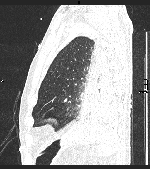 Acute aspiration pneumonitis (Radiopaedia 55642-62166 Sagittal lung window 22).jpg