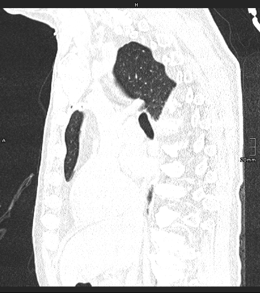 Acute aspiration pneumonitis (Radiopaedia 55642-62166 Sagittal lung window 89).jpg