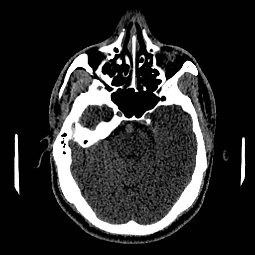 File:Acute basilar artery occlusion (Radiopaedia 43582-46985 Axial non-contrast 65).jpg