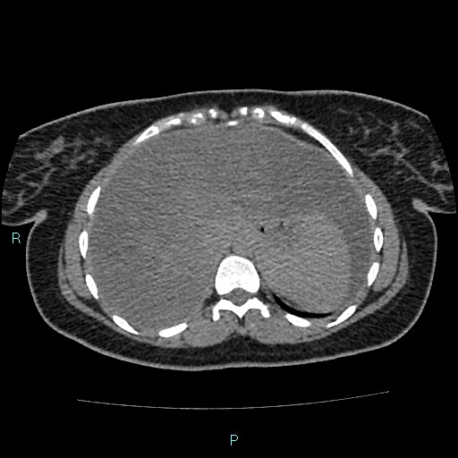 Acute bilateral pyelonephritis (Radiopaedia 37146-38881 Axial non-contrast 17).jpg