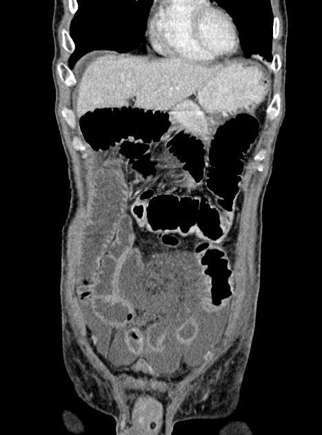 Acute bowel ischemia (Radiopaedia 87695-104114 Coronal C+ portal venous phase 120).jpg