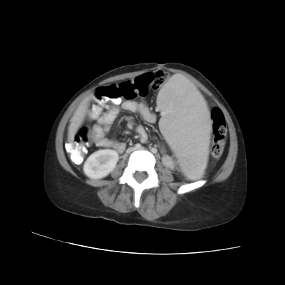 Acute calculous cholecystitis in patient with osteopetrosis (Radiopaedia 77871-90159 Axial C+ portal venous phase 51).jpg