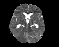 File:Acute cerebellar ataxia (Radiopaedia 61487-69446 Axial ADC 9).jpg