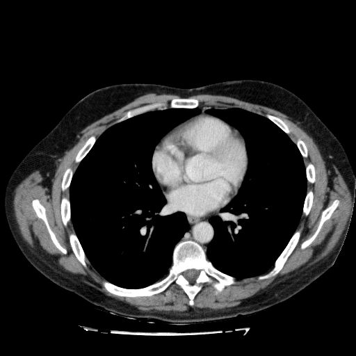 File:Acute cholecystitis and incidental left sided IVC (Radiopaedia 49352-54459 Axial C+ portal venous phase 10).jpg
