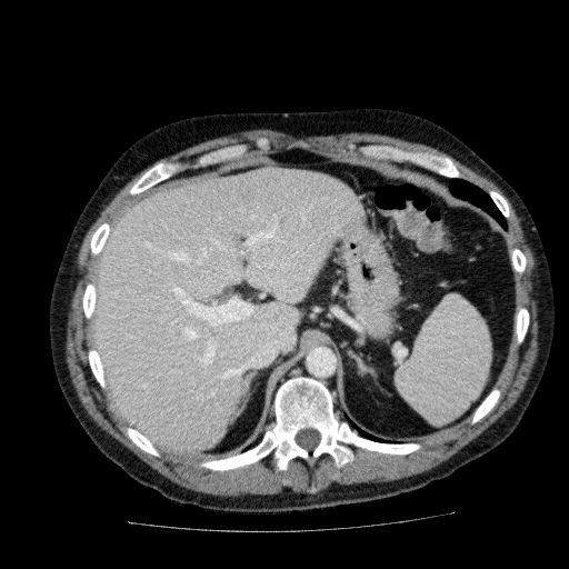Acute cholecystitis and incidental left sided IVC (Radiopaedia 49352-54459 Axial C+ portal venous phase 41).jpg