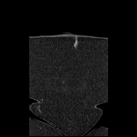 File:Acute cholecystitis and ureteric colic (Radiopaedia 42330-45444 Coronal prone 11).jpg