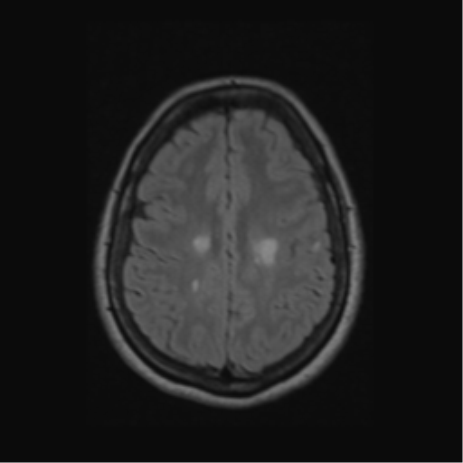 Acute disseminated encephalomyelitis (ADEM) (Radiopaedia 38073-40065 Axial FLAIR 48).png