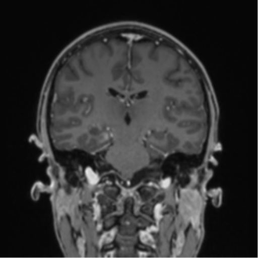 Acute disseminated encephalomyelitis (ADEM) (Radiopaedia 65319-74349 Coronal T1 C+ 19).png