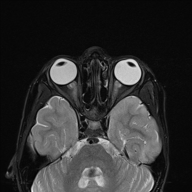 File:Acute disseminating encephalomyelitis with bilateral optic neuritis (Radiopaedia 79676-92886 Axial STIR 7).jpg