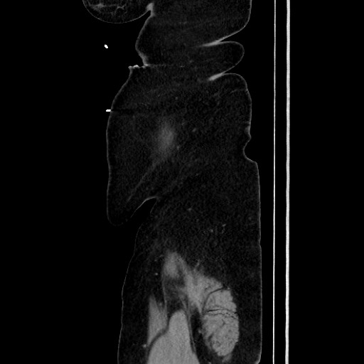 Acute diverticulitis - transverse colon (Radiopaedia 87063-103327 Sagittal C+ portal venous phase 206).jpg