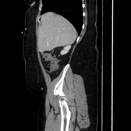 Acute diverticulitis - transverse colon (Radiopaedia 87063-103327 Sagittal C+ portal venous phase 72).jpg