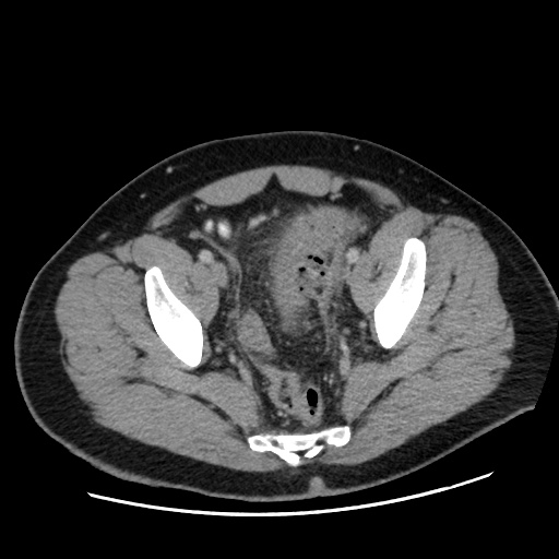 File:Acute diverticulitis with localized perforation (Radiopaedia 41296-44113 Axial C+ portal venous phase 78).jpg