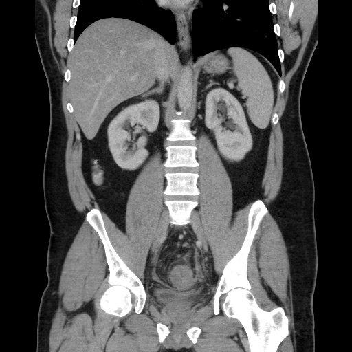 Acute diverticulitis with localized perforation (Radiopaedia 41296-44113 Coronal C+ portal venous phase 38).jpg