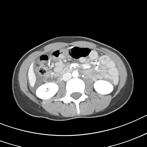 Acute gangrenous appendicitis with perforation (Radiopaedia 40152-42662 Axial C+ portal venous phase 32).png