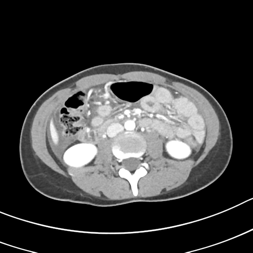 Acute gangrenous appendicitis with perforation (Radiopaedia 40152-42662 Axial C+ portal venous phase 34).png