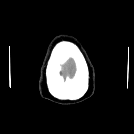 Acute hemorrhagic stroke (Radiopaedia 17507-17223 Axial non-contrast 49).jpg