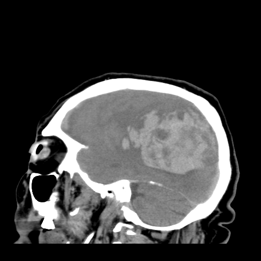 File:Acute hemorrhagic stroke (Radiopaedia 17507-17223 Sagittal non-contrast 12).jpg