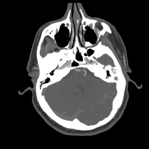 File:Acute internal carotid artery dissection (Radiopaedia 53541-59630 D 21).jpg