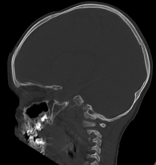 Acute mastoiditis (Radiopaedia 82678-96881 Sagittal bone window 39).jpg