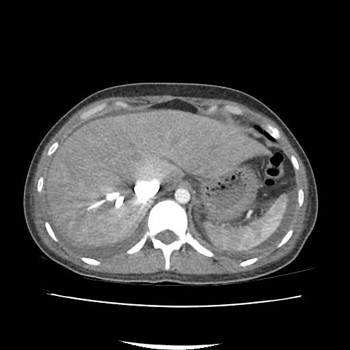 Acute myocarditis (Radiopaedia 55988-62613 Axial C+ portal venous phase 15).jpg