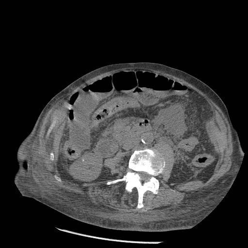 Acute on chronic pancreatitis (Radiopaedia 13233-13244 Axial non-contrast 55).jpg