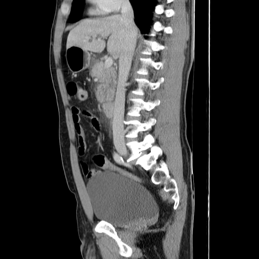 Acute pancreatitis (Radiopaedia 22572-22596 Sagittal C+ portal venous phase 24).jpg