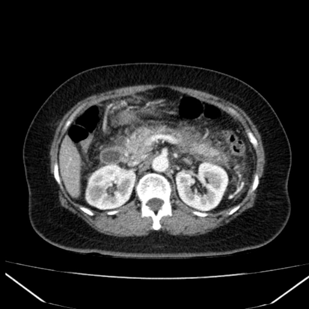 Acute pancreatitis - Balthazar C (Radiopaedia 26569-26714 Axial C+ arterial phase 33).jpg