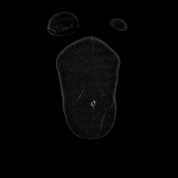 Acute pancreatitis - Balthazar C (Radiopaedia 26569-26714 Coronal C+ portal venous phase 5).jpg