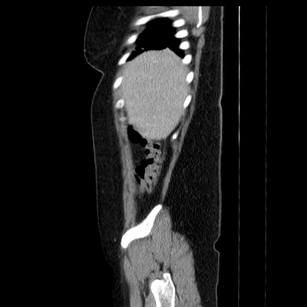 Acute pancreatitis - Balthazar C (Radiopaedia 26569-26714 Sagittal C+ portal venous phase 13).jpg