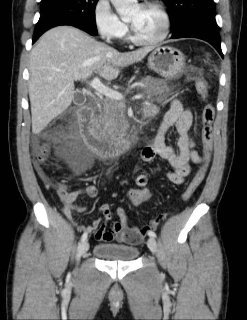 Acute pancreatitis - Balthazar E (Radiopaedia 23080-23110 Coronal C+ portal venous phase 34).jpg