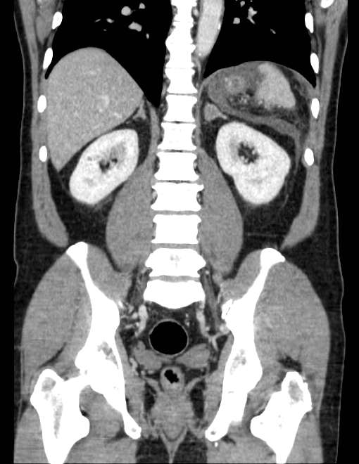 Acute pancreatitis - Balthazar E (Radiopaedia 23080-23110 Coronal C+ portal venous phase 55).jpg