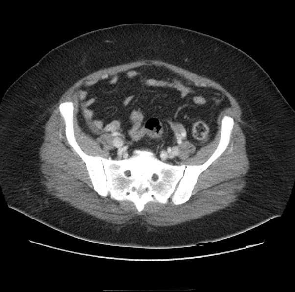 File:Acute pancreatitis - Balthazar E (Radiopaedia 29016-29377 Axial C+ portal venous phase 56).png