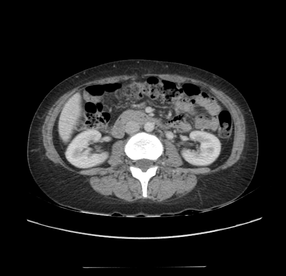 File:Acute pancreatitis - Balthazar E - post ERCP (Radiopaedia 27562-27772 Axial C+ portal venous phase 37).png