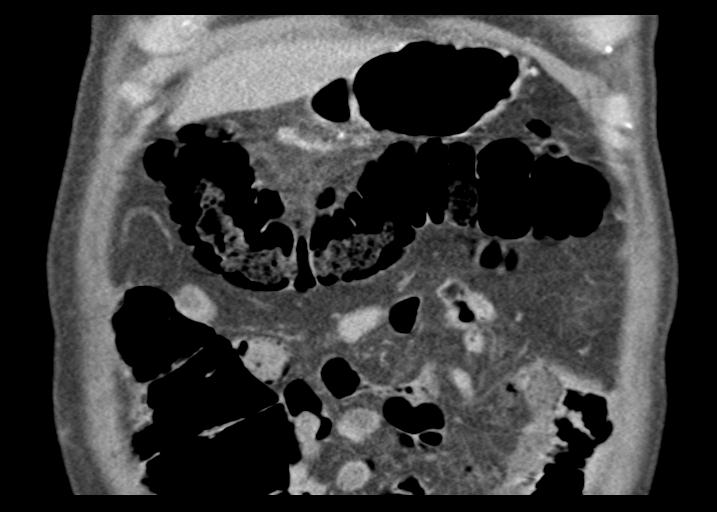 Acute pancreatitis and walled-off necrosis (Radiopaedia 29888-30403 Coronal C+ portal venous phase 14).jpg
