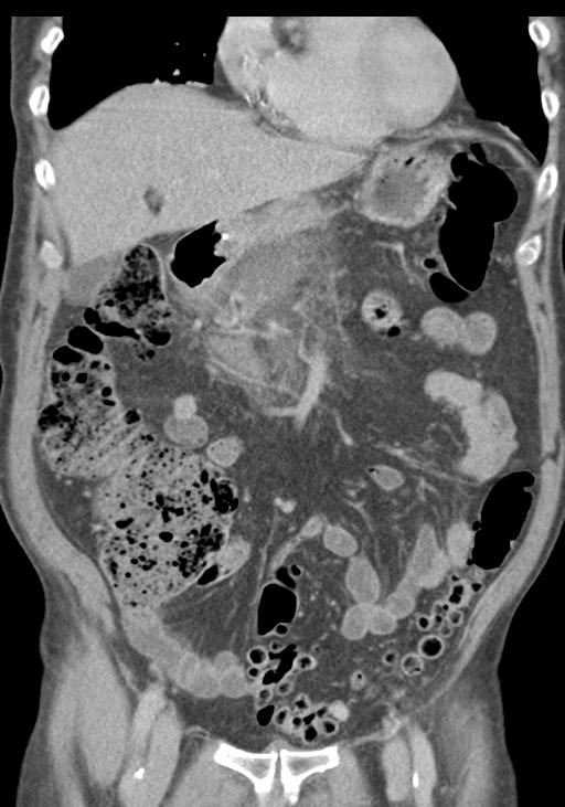 Acute pancreatitis and walled-off necrosis (Radiopaedia 29888-30403 E 21).jpg