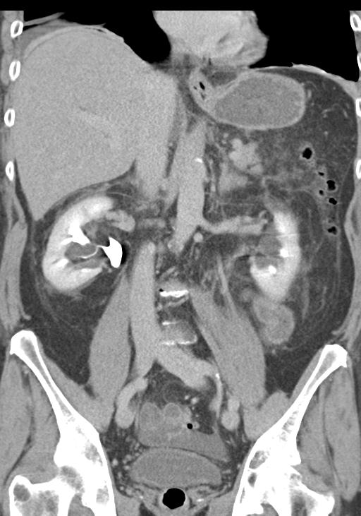 Acute pancreatitis and walled-off necrosis (Radiopaedia 29888-30403 E 33).jpg