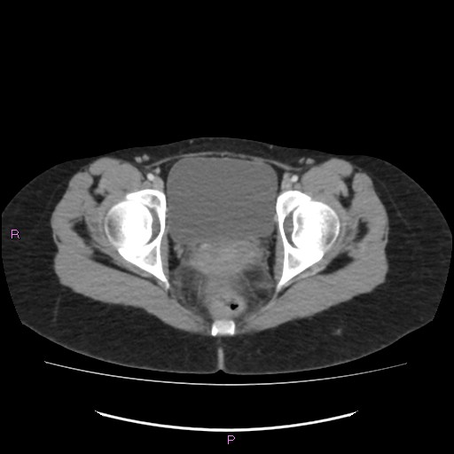 Acute pancreatitis secondary to stone at minor papilla and pancreatic divisum (Radiopaedia 76570-88333 Axial C+ portal venous phase 76).jpg