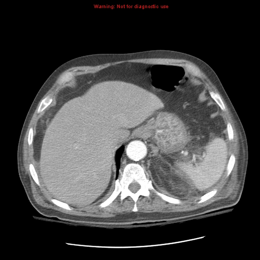 File:Acute pancreatitis with incidental pancreatic lipoma (Radiopaedia 10190-10730 Axial C+ arterial phase 22).jpg