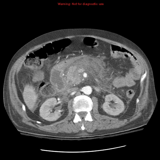 Acute pancreatitis with incidental pancreatic lipoma (Radiopaedia 10190-10730 Axial C+ arterial phase 45).jpg