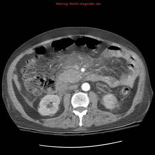 Acute pancreatitis with incidental pancreatic lipoma (Radiopaedia 10190-10730 Axial C+ arterial phase 50).jpg