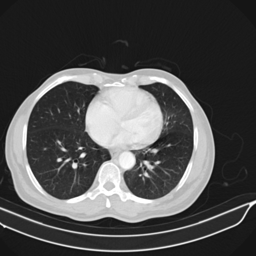 Acute pulmonary embolism (Radiopaedia 69510-79390 Axial lung window 57).jpg