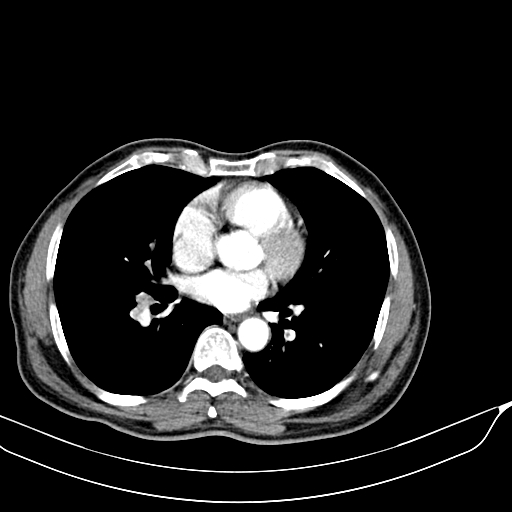 File:Acute pulmonary embolism (Radiopaedia 69510-79390 D 34).jpg