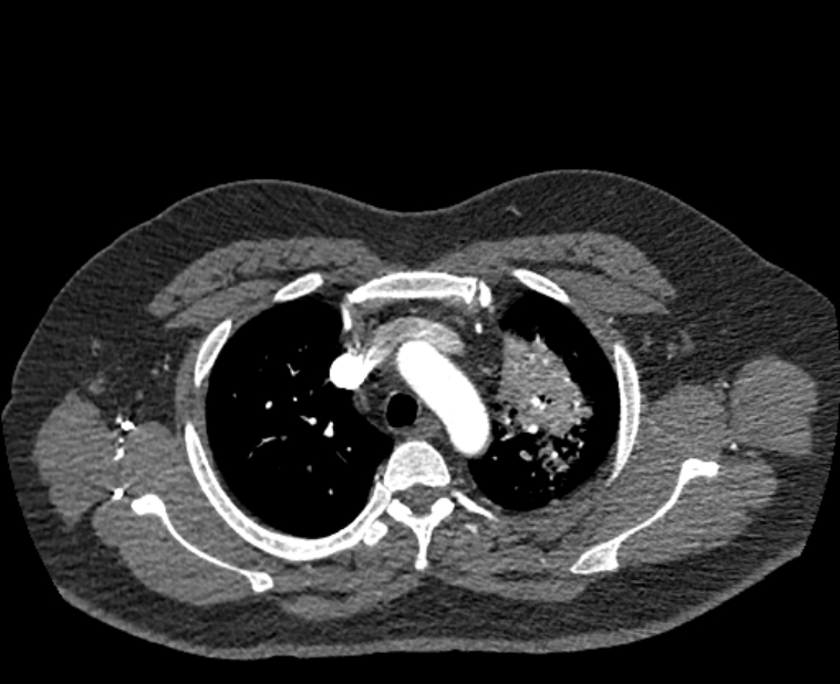 Acute pulmonary embolism with pulmonary infarcts (Radiopaedia 77688-89908 Axial C+ CTPA 12).jpg