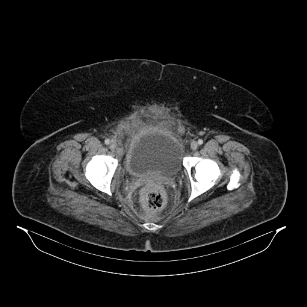 Acute pyelonephritis (Radiopaedia 25657-25837 Axial renal parenchymal phase 75).jpg